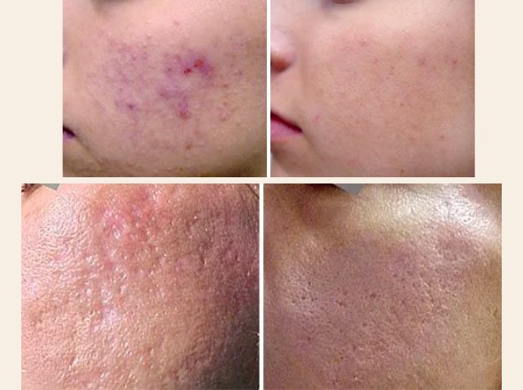 tratamentos 590 x 440 acne e cicatriz